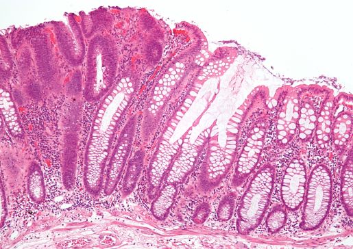 colorectal cancer micrograph